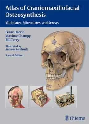 Atlas of Craniomaxillofacial Osteosynthesis : Microplates, Miniplates, and Screws