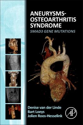 Aneurysms-Osteoarthritis Syndrome : SMAD3 Gene Mutations