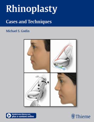Rhinoplasty : Cases and Techniques