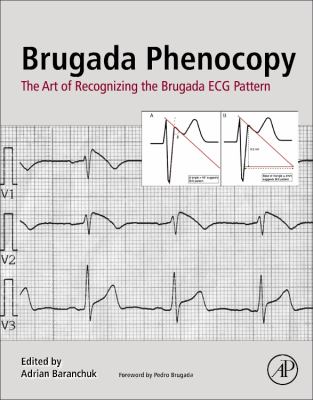 Brugada Phenocopy : The Art of Recognizing the Brugada ECG Pattern