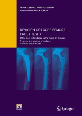 Revision of Loose Femoral Prostheses with a Stem System Based on the Press-Fit Principle : A Concept and Its System of Implants, a Method and Its Results